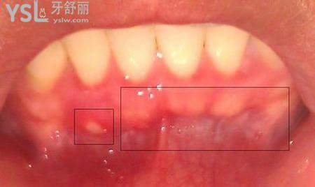 牙龈肿痛不能吃什么东西?