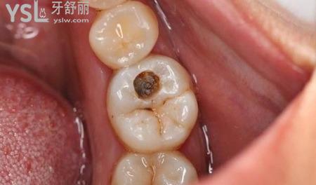 龋齿会痛吗？