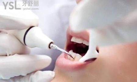 洗牙两小时后能抽烟吗?