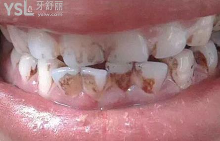 牙齿不好是怎么回事?