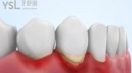 得了牙周炎 要怎么治疗呢?