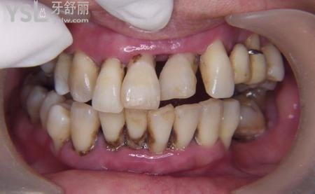 牙龈萎缩是什么原因,牙龈萎缩怎么?