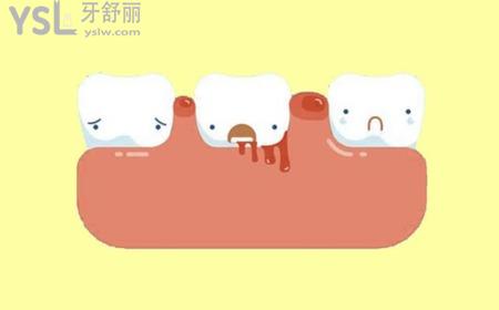 牙齿一吸就出血是什么原因?