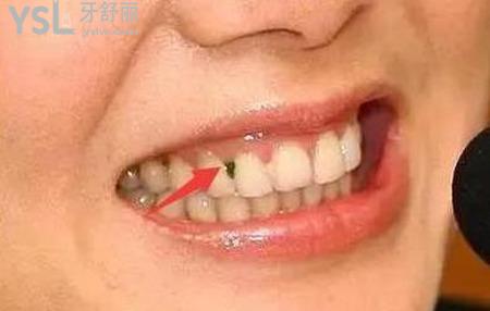 牙缝塞东西,抠出来很臭是怎么回事?