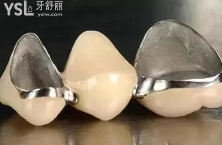 烤瓷牙是怎么安装的？