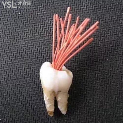 牙疼根管治疗是什么意思？