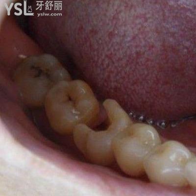 拔牙后根尖炎会消除吗？根尖炎要怎么治疗？