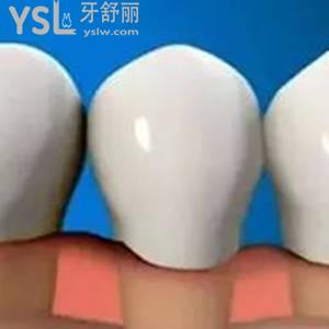 为什么会牙龈萎缩 应该怎么治疗？