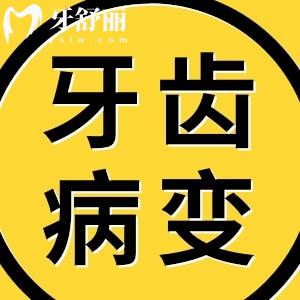 一颗健康的牙齿是怎么发展成为一颗烂牙的?其实只有简单几步