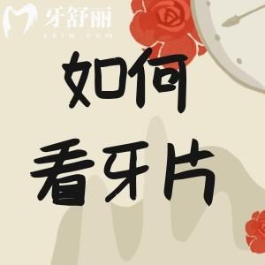 牙科拍的牙片怎么看?叫你简单几步看牙片不被坑