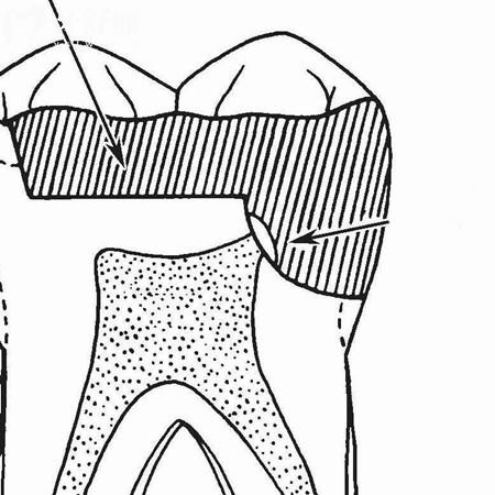 什么是牙髓再生术？