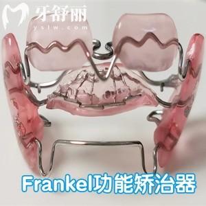 Frankel功能矫治器