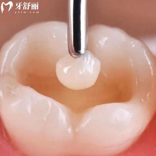 有蛀牙了，有没有知道第一次补牙流程和注意事项的？