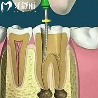 根管治疗会造成牙根隐裂吗?会出现几种情况并附上治疗措施