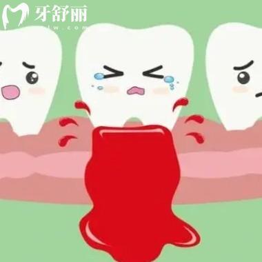 牙龈出血要警惕三种病：牙周病/血液病/全身疾病不容小觑