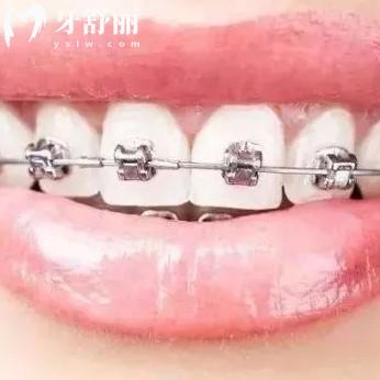 牙套多少钱价格表2024全新版，附金属透明牙套排行前十