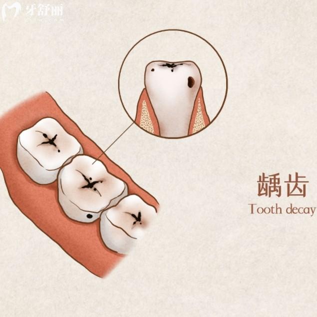 牙齿烂到什么程度就不能补了？盘点不同程度的蛀牙修复方法