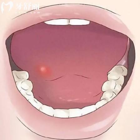 口腔溃疡经常反复是怎么回事？需要注意吗？