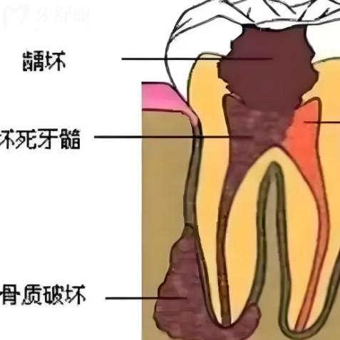 急性牙髓炎和慢性牙髓炎有什么区别？