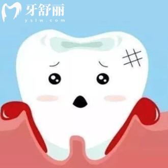 牙周炎会导致年纪轻轻掉牙吗?怎么治疗比较好呢