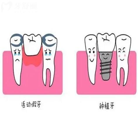 镶牙与种牙有什么区别？从价格收费/使用感/使用寿命多方解答