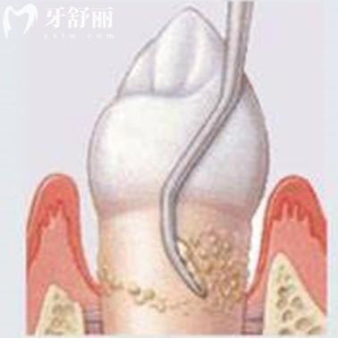 龈下刮治能治好牙周炎吗?可以缓解很有必要做且要做2-4次