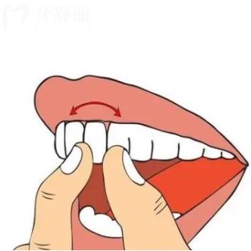 牙齿松动能自己恢复吗？一度二度三度松动都是如何治疗的？