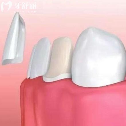 牙贴面需要磨损牙齿吗?从价格/优点和缺点看大约磨0.5-1mm左右可维持多年