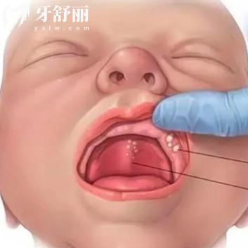 新生儿的口腔需要清洁吗？