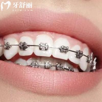 告知曲靖正规口腔医院收费标准是怎样的，价目表更新包含舌侧隐形矫正等项目