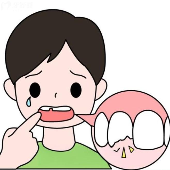 乳牙磕断了一半怎么办？直接拔掉还是修复？