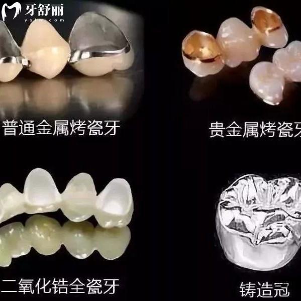 爱尔创全瓷牙冠质保几年？