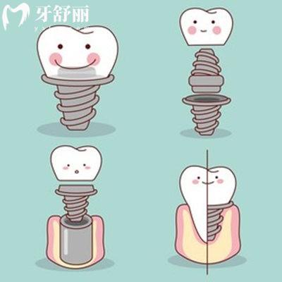 登特斯dentis种植牙是哪国的？质量怎么样？从优缺点、价格、使用寿命多个方面介绍