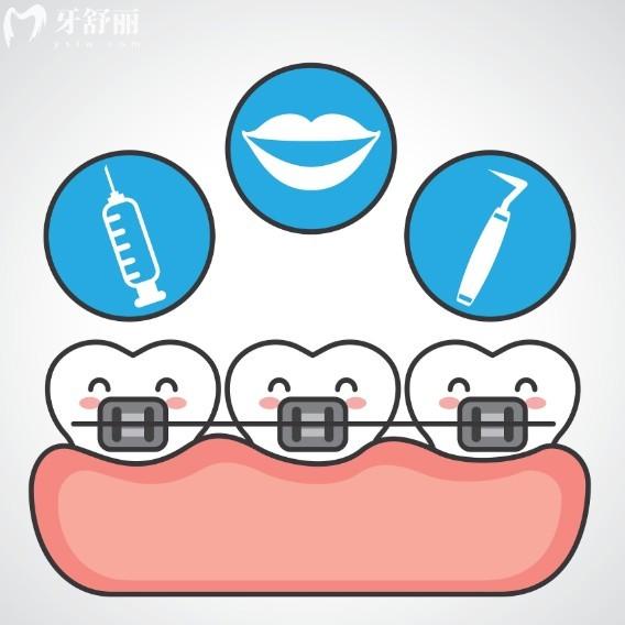 正畸小白必知:自锁VS非自锁托槽哪个好?对比材质/疗效/价格等区别