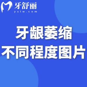 牙龈萎缩不同程度图片分享:牙龈萎缩各个阶段及症状图片大全分享