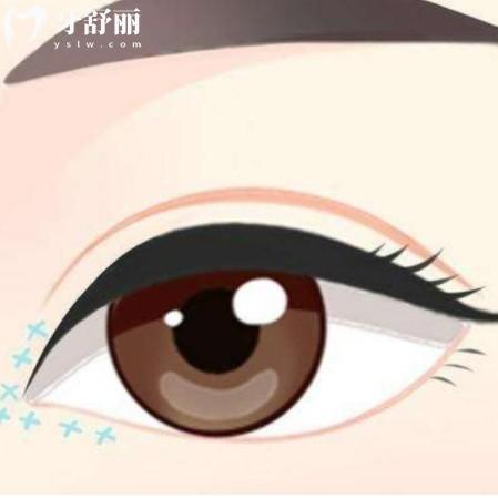 张莹莹做双眼皮怎么样?在沈阳杏林整形外科坐诊技术优势解读