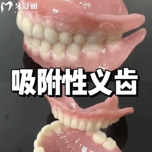 瑞士义获嘉BPS吸附性义齿优缺点全解析，看完再做决定