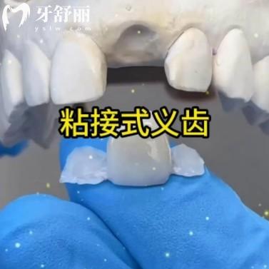 粘接桥修复优缺点分析:不磨牙的补牙法,真香还是踩坑?