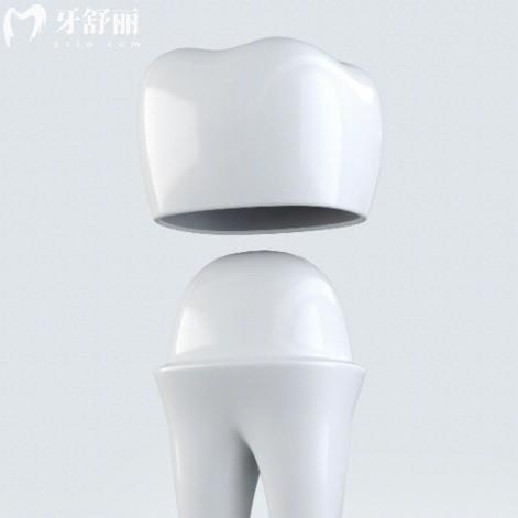 ​​德国牙冠哪家强？威兰德/泽康/西诺德六大品牌价格、特点一篇看懂！​