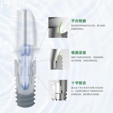 国产康盛种植体怎么样??3000元起的种牙好选择,糖尿病人也适用