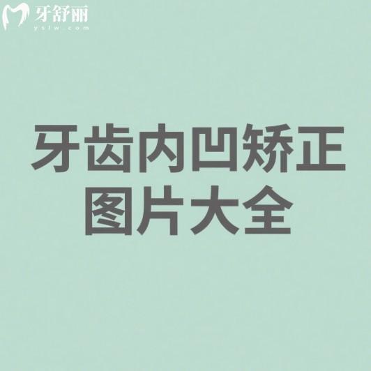 一键查看牙齿内凹矫正图片大全,还有治疗方案及价格表,把握儿童矫正黄金期