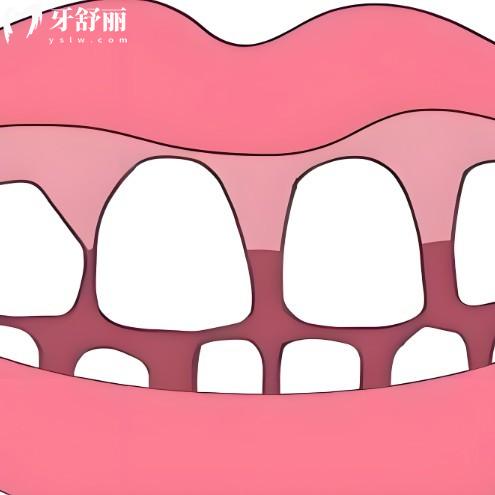 门牙牙缝大修复比较好的方法及价格表:对比不同修复方式的持久性及美观度