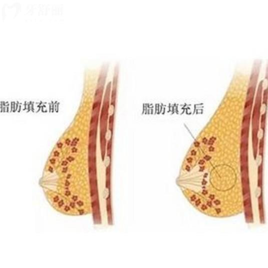 脂肪隆胸后多久能侧睡?简单易懂术后指南请收好
