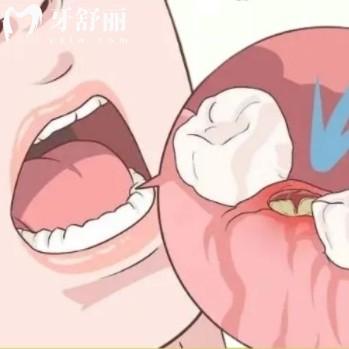拔牙后的干槽症有哪些表现?简单四大症状可以自查