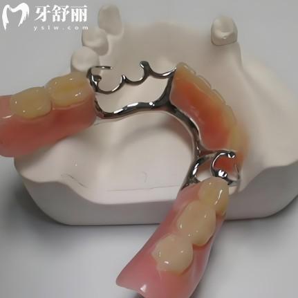 无挂钩镶牙：不用“铁丝勾”也能固定假牙？揭秘这种“黑科技”镶牙法！