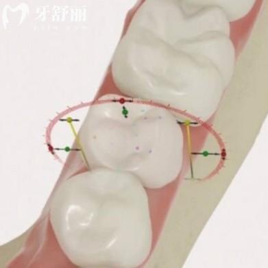 Dio种植体不是杂牌！韩系“性价比王”的真相大揭秘