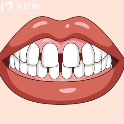 牙缝变大怎么修复比较好?以下是几种改善的简单办法