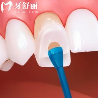 牙齿贴面有年龄门槛？18岁以下为何被“劝退”？