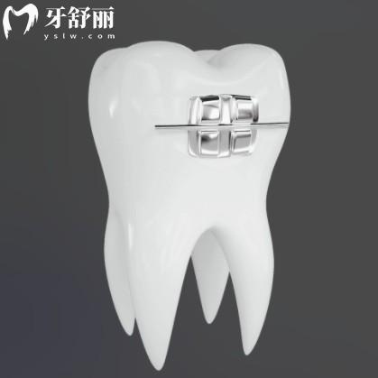 自锁托槽选国产还是进口？区别大吗？一文读懂性价比与适配性