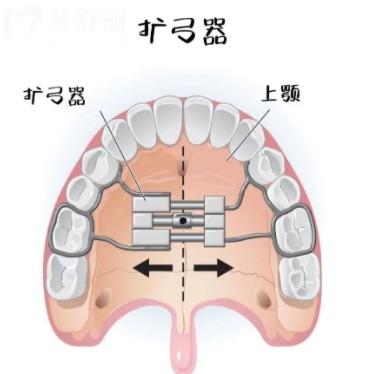 扩弓器戴多久能出牙缝？揭秘牙齿矫正的“牙缝生长时间表”